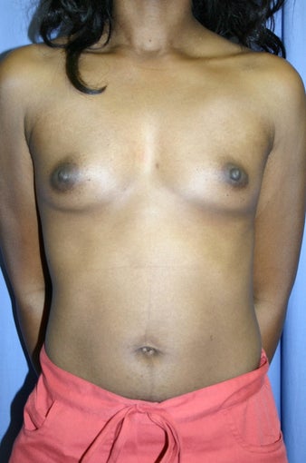 Breast Augmentation 
