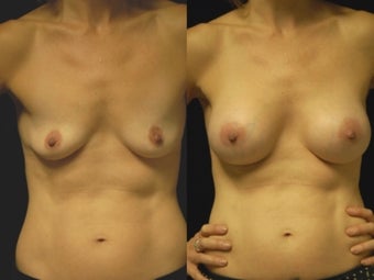 Breast augmentation, gel implants