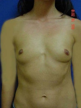 Breast Augmentation