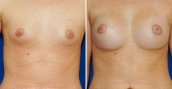 Breast Implants