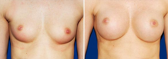 Breast Implants