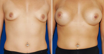 Breast Implants