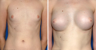 Breast Implants
