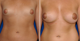 Breast Implants