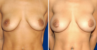 Breast Implants