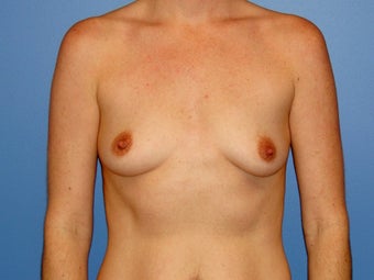 Breast augmentation with saline implants