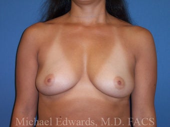 Breast Augmentation 