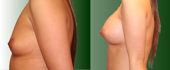 Breast Augmentation