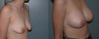 Breast Augmentation (A cup to C cup)