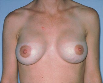 Breast Lift