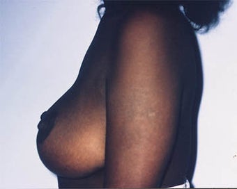 Breast Lift