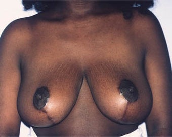 Breast Lift