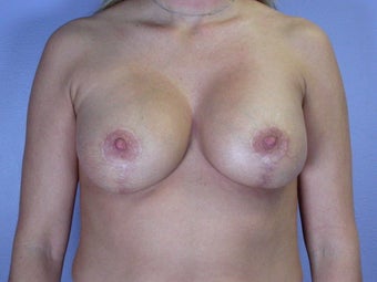 Breast Lift / Breast Augmentation 