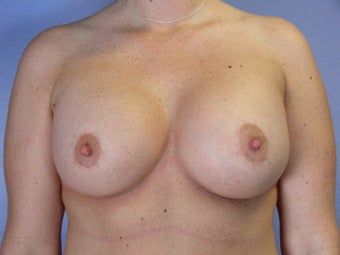 Breast Lift / Breast Augmentation   