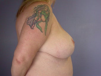 Breast Lift / Breast Augmentation