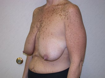 Breast Lift Surgery