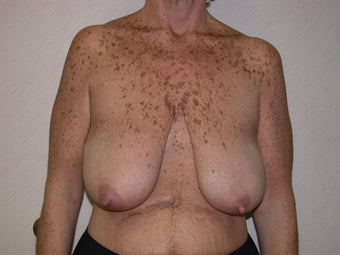 Breast Lift Surgery