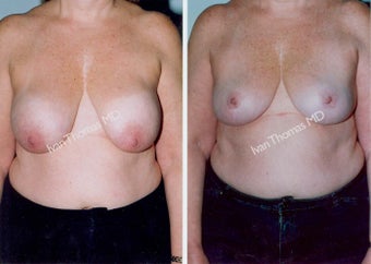 Implant removal and Breast lift