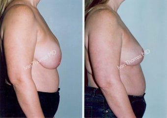 Implant removal and Breast lift