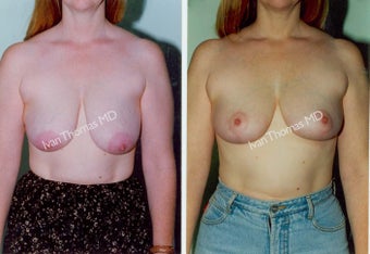 Breast Lift