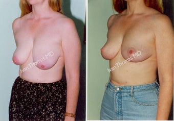 Mastopexy-Breast Lift
