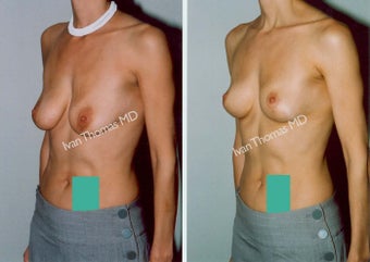 Mastopexy-Breast Lift