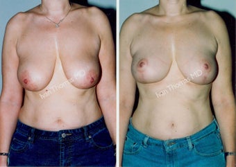 Mastopexy-Breast Lift