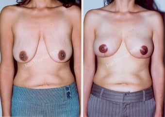 Mastopexy-Breast Lift
