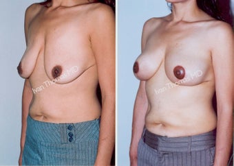Mastopexy-Breast Lift