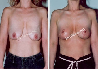 Mastopexy-Breast Lift