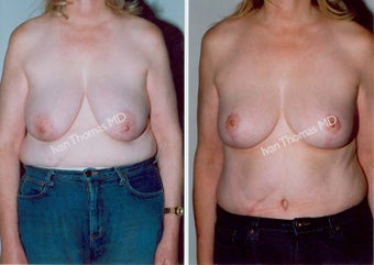 Mastopexy-Breast Lift