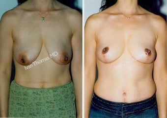 Mastopexy-Breast Lift