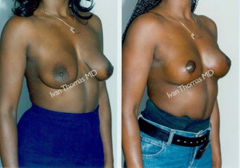 Mastopexy-Breast Lift