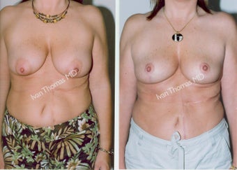Mastopexy-Breast Lift