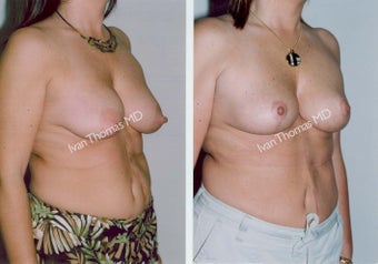 Mastopexy-Breast Lift