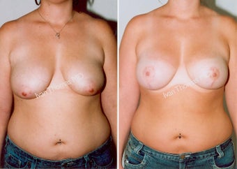 Mastopexy-Breast Lift