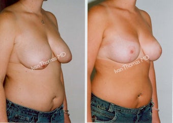 Mastopexy-Breast Lift