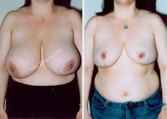 Breast Reduction