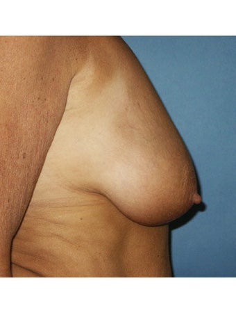  Bilateral mastopexy augmentation with placement of smooth saline breast implants. Right implant 300cc filled with 360cc, left i