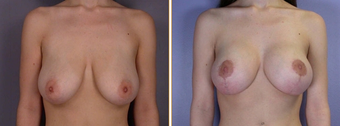 Mastopexy, Breast Lift