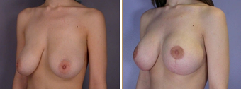 Mastopexy, Breast Lift