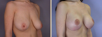 Mastopexy, Breast Lift