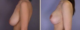 Mastopexy, Breast Lift