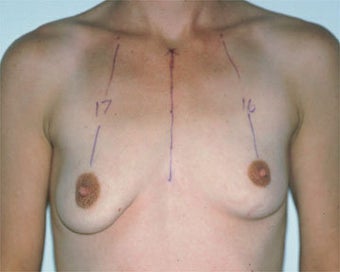 Breast Lift