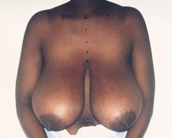 Breast Lift