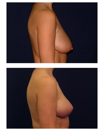 Breast Lift / Mastopexy
