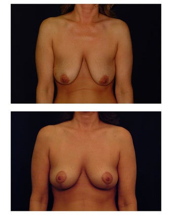 Breast Lift / Mastopexy