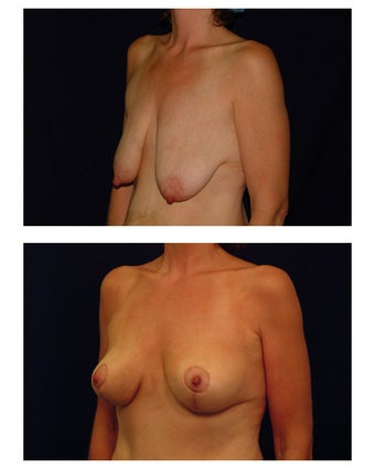 Breast Lift / Mastopexy