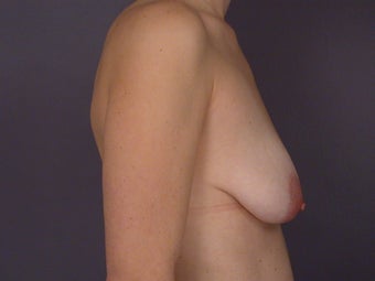 Breast Lift / Breast Augmentation 
