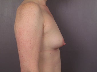 Breast Lift / Breast Augmentation 